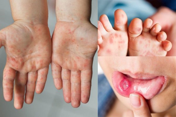 3 dấu hiệu cảnh báo bệnh tay chân miệng giai đoạn nặng ở trẻ nhỏ