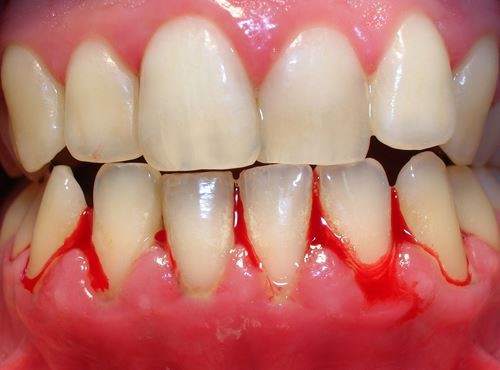 Chăm sóc sức khoẻ răng miệng cho bệnh nhân đái tháo đường