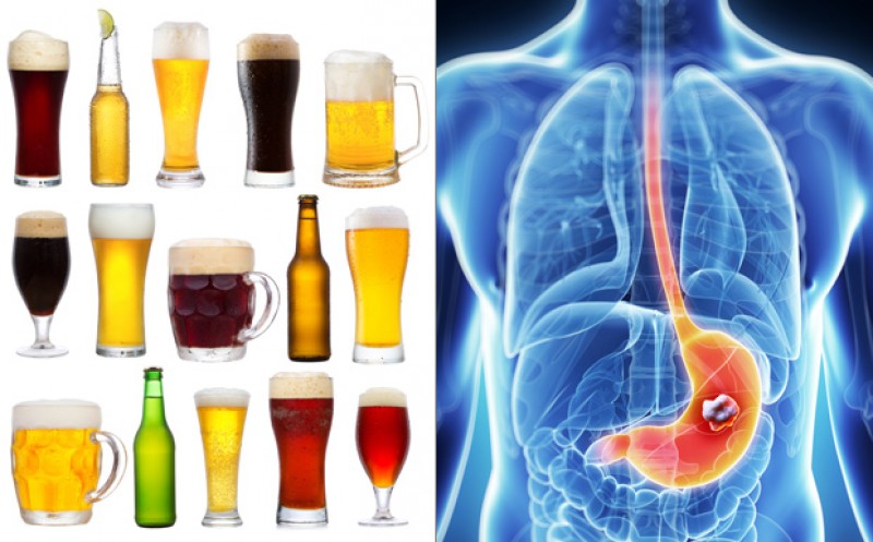 Hiểu biết về rượu, bia và ung thư