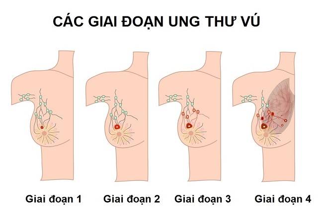 Ung thư vú: Dấu hiệu, nguyên nhân, cách phòng tránh và điều trị