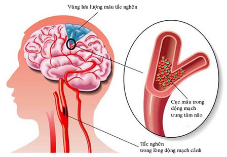 80% nguy cơ đột quỵ xảy ra vào buổi sáng