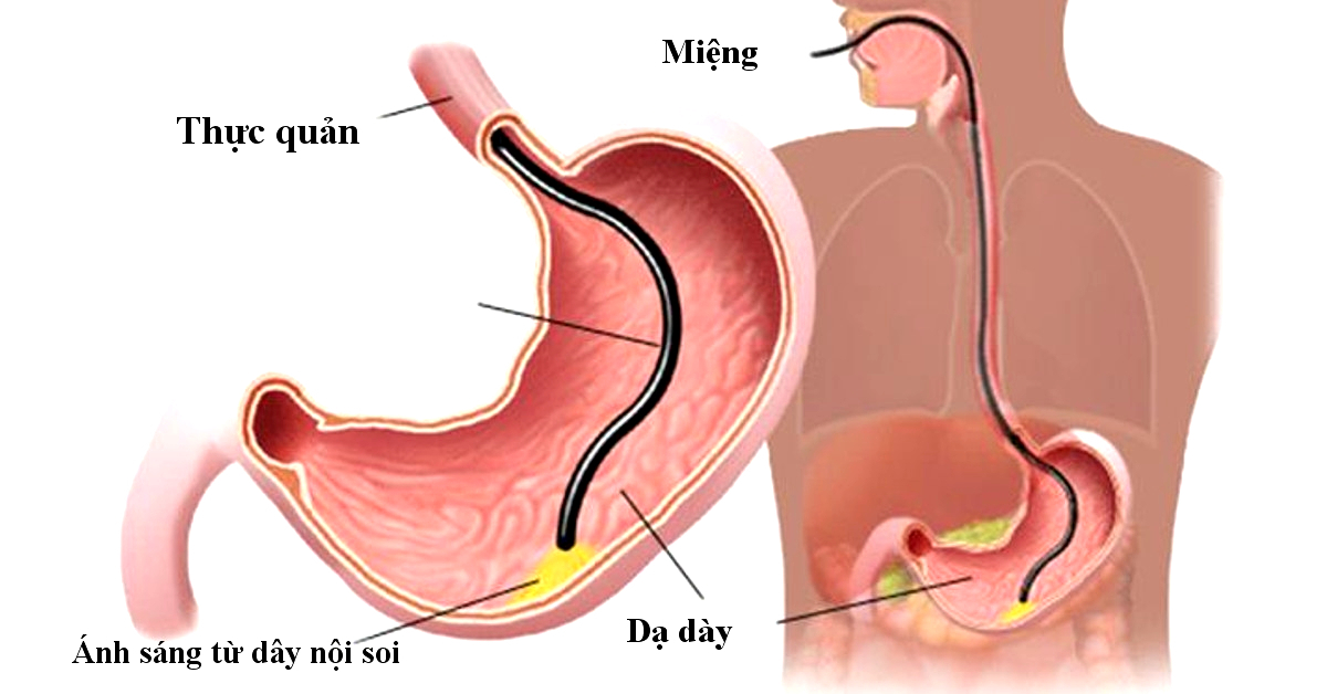 Ưu điểm và quy trình nội soi dạ dày không đau