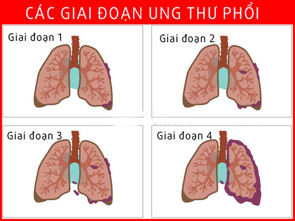 benh ung thu phoi co may giai doan